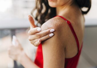 Saiba como cuidar de queimadura e veja 7 dicas para ajudar na cicatrização e recuperação da pele