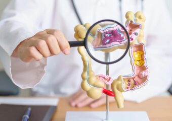 O que você precisa saber sobre a doença de Crohn